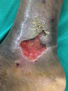 Varicose Ulcer