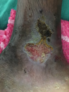 Varicose Ulcer after 3 days treatment