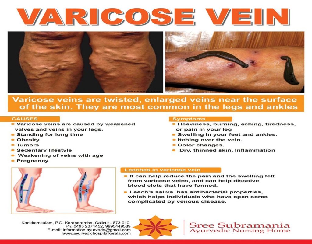 Effective Treatment for Varicose Veins