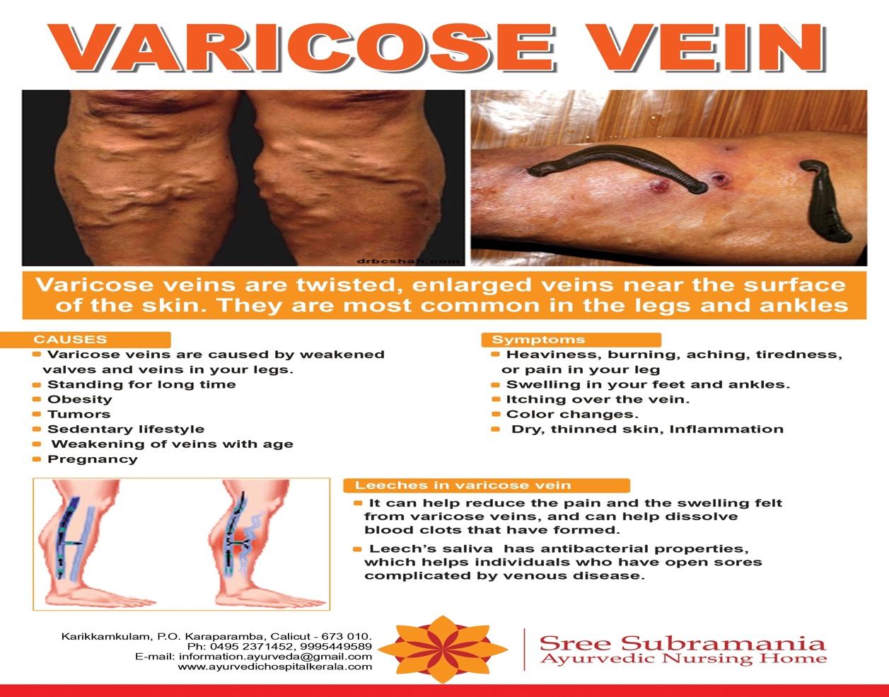 Treatments for Varicose Veins Sree Subramania Hospital