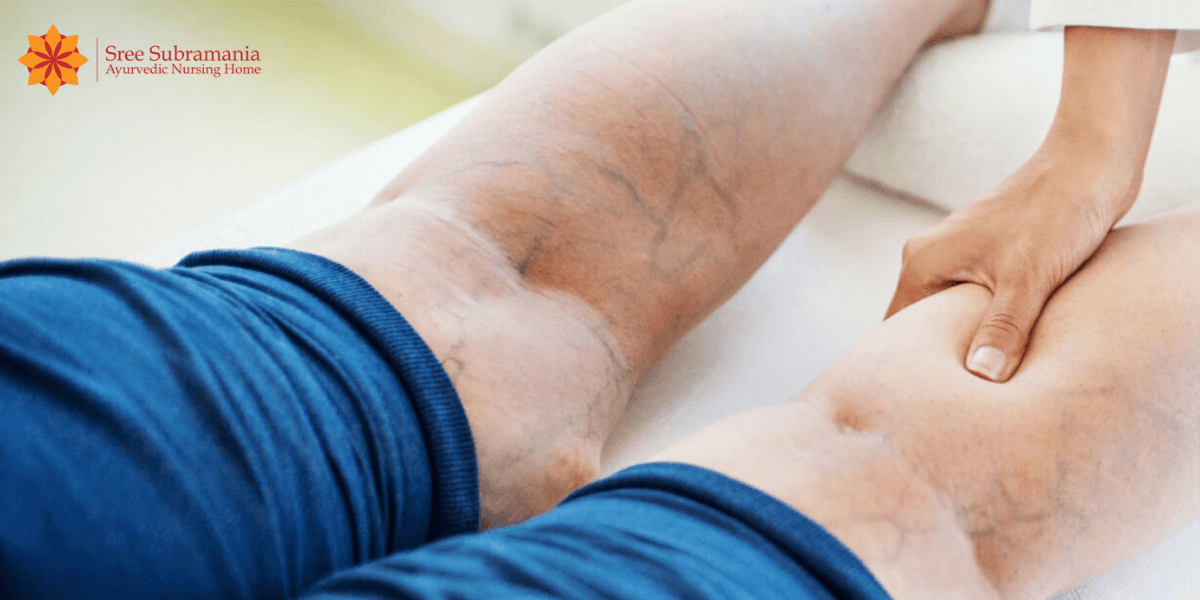 Specialised Treatment for Varicose Vein [Treat Varicose Vein without  Surgery] - Sree Subramania Hospital