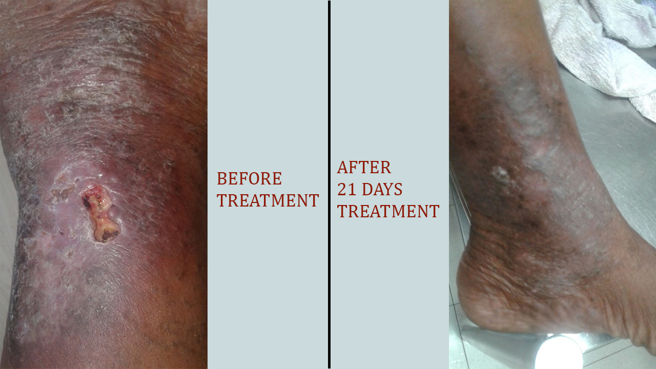 Leech Therapy For Varicose Veins