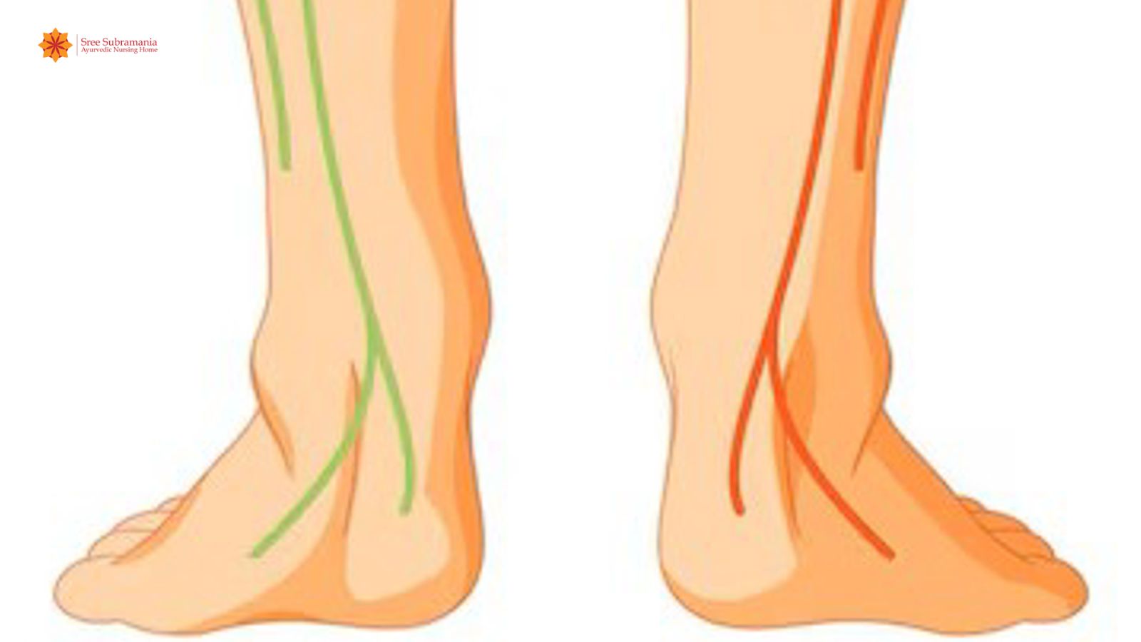 Panchkarma Treatment for DVT