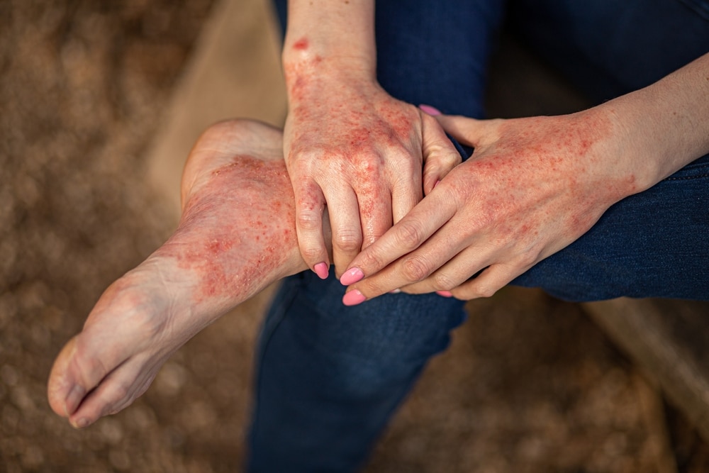 Best Treatment for Psoriasis