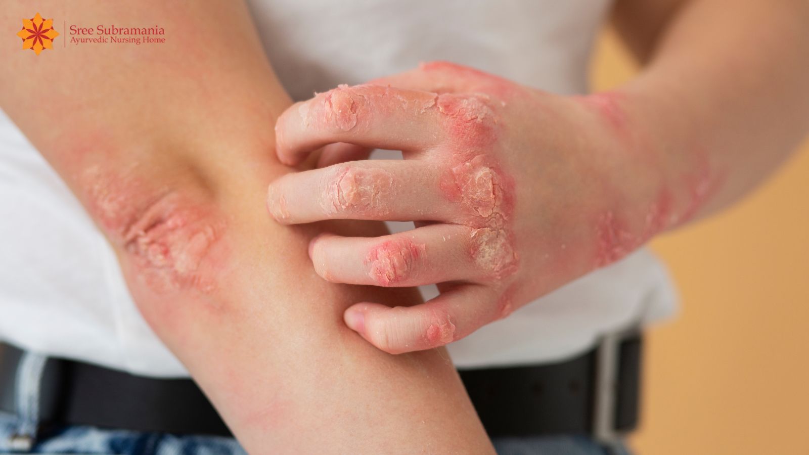 Psoriasis Treatment for Tamil Nadu Patients